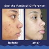 PanOxyl, очищающая пенка от акне, для лица и тела, максимальная эффективность, 85 г (3 унции)